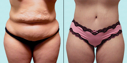 breast implants and tummy tuck price